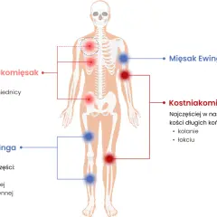 Schemat pokazuje, jak wygląda mięsak: chrzęstniakomięsak w miednicy, żebrach, łopatkach; kostniakomięsak w kolanach, łokciach; mięsak Ewinga w piszczelach, kościach udowych, ramiennych.