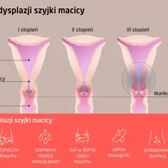 Ilustracja przedstawia stadia dysplazji szyjki macicy: I, II i III stopień, z zaznaczoną tkanką uszkodzoną w III stadium. Poniżej objawy: ból podczas stosunku, plamienia, ból brzucha, obfite miesiączki, podrażnienie pochwy.