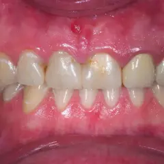 Podrażnione dziąsła: Szybka ulga i trwałe rozwiązanie. Kiedy do dentysty?