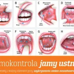 Rak dziąsła: Jak wygląda? Kluczowe objawy i co robić.