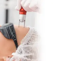 Zabieg laserowy na twarz w klinice dermatologii estetycznej.