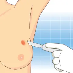 Lekarz w białej rękawiczce wykonuje biopsję cienkoigłową podejrzanej zmiany na piersi.