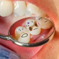 Zepsute ząbki z narysowanymi buźkami w lusterku dentystycznym. Brakuje im zdrowego **hydroksyapatytu**.