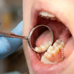 Dentysta bada zęby, szukając próchnicy między zębami.