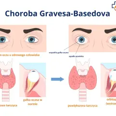 Ilustracja porównuje zdrowe oczy i tarczycę z objawami choroby Gravesa-Basedova: wytrzeszczem, opadającą powieką i zaczerwienieniem.