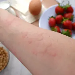 Ręka z zaczerwienioną wysypką pokarmową, obok miseczka z ziarnami, jajko, mleko i truskawki.