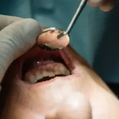 Dentysta bada jamę ustną, widoczne są zęby i dziąsła. Może to być nieleczony ropień zęba.