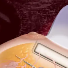 Ilustracja przedstawia biopsję piersi. Igła biopsyjna jest wprowadzana do tkanki piersi pod kontrolą ultrasonografu.