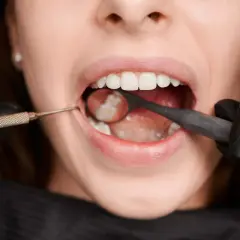 Usta pacjentki z widocznymi białymi plamami na zębach, badane przez dentystę przy użyciu lusterka i narzędzia.