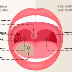 Porównanie objawów bólu gardła: bakteryjne zapalenie gardła z nalotem na migdałkach i języku, obrzękiem uvuli.