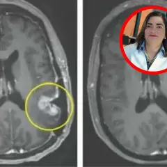 Porównanie rezonansów mózgu: czy glejak jest uleczalny? Lekarka w czerwonym okręgu analizuje obraz z widocznym guzem.