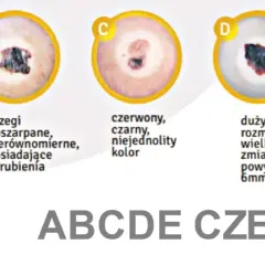 ABCDE czerniaka: asymetria, brzegi, kolor, duży rozmiar, ewolucja. Zmiany na ustach mogą być niepokojące.