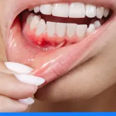 Opuchnięte dziąsła: Domowe sposoby, które działają! Kiedy do dentysty?