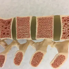Model kręgosłupa z widocznymi ubytkami w kościach, ilustrujący osteoporozę objawy.