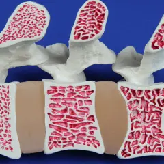 Model kręgosłupa z widoczną strukturą kości. Po lewej kość zdrowa, po prawej widoczne ubytki świadczące o osteoporozie.