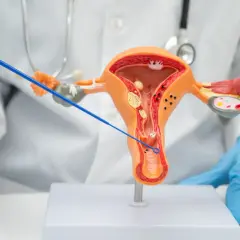 Model narządu rodnego kobiety z zaznaczonymi zmianami, sugerującymi raka pochwy. Lekarz w rękawiczkach pokazuje narzędziem obszar dotknięty chorobą.