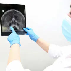 Lekarz w niebieskich rękawiczkach wskazuje palcem na zdjęcie rentgenowskie czaszki, analizując potencjalny kostniak.
