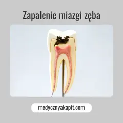 Model zęba ukazujący próchnicę sięgającą miazgi, co może prowadzić do zapalenia miazgi.