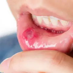 Afta a dentysta: Kiedy iść, a kiedy przełożyć wizytę?