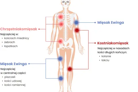 Schemat pokazuje, jak wygląda mięsak: chrzęstniakomięsak w miednicy, żebrach, łopatkach; kostniakomięsak w kolanach, łokciach; mięsak Ewinga w piszczelach, kościach udowych, ramiennych.