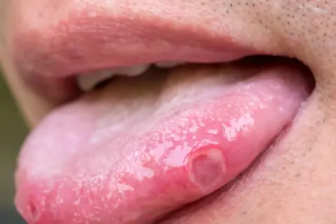 Widoczne zapalenie języka z licznymi owrzodzeniami na jego powierzchni. Język jest zaczerwieniony i opuchnięty.