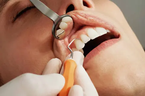 Dentysta używa narzędzi do ekstrakcji zęba. Widoczne są usta pacjenta, lustro dentystyczne i narzędzie.