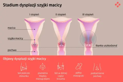 Ilustracja przedstawia stadia dysplazji szyjki macicy: I, II i III stopień, z zaznaczoną tkanką uszkodzoną w III stadium. Poniżej objawy: ból podczas stosunku, plamienia, ból brzucha, obfite miesiączki, podrażnienie pochwy.