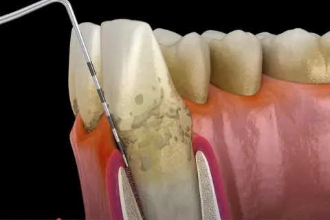 Ząb z kamieniem nazębnym i stanem zapalnym dziąseł. Narzędzie dentystyczne usuwa osad, łagodząc ból wszystkich zębów.