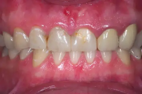Podrażnione dziąsła: Szybka ulga i trwałe rozwiązanie. Kiedy do dentysty?