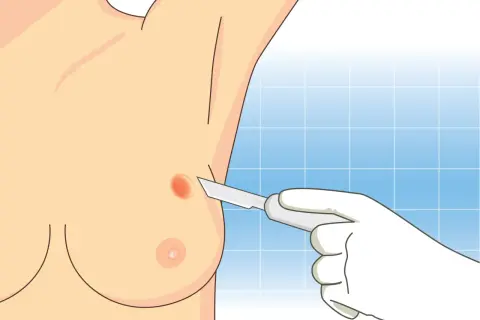 Lekarz w białej rękawiczce wykonuje biopsję cienkoigłową podejrzanej zmiany na piersi.