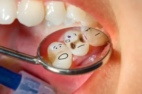 Zepsute ząbki z narysowanymi buźkami w lusterku dentystycznym. Brakuje im zdrowego **hydroksyapatytu**.