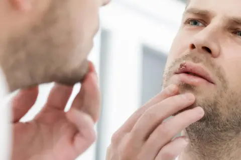 Opryszczka a dentysta: Kiedy wizyta jest bezpieczna i dlaczego?