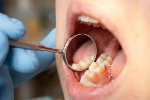 Dentysta bada zęby, szukając próchnicy między zębami.