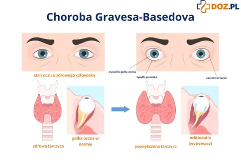Ilustracja porównuje zdrowe oczy i tarczycę z objawami choroby Gravesa-Basedova: wytrzeszczem, opadającą powieką i zaczerwienieniem.