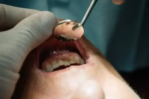 Dentysta bada jamę ustną, widoczne są zęby i dziąsła. Może to być nieleczony ropień zęba.