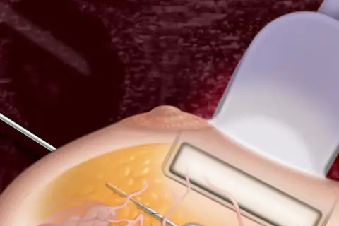 Ilustracja przedstawia biopsję piersi. Igła biopsyjna jest wprowadzana do tkanki piersi pod kontrolą ultrasonografu.