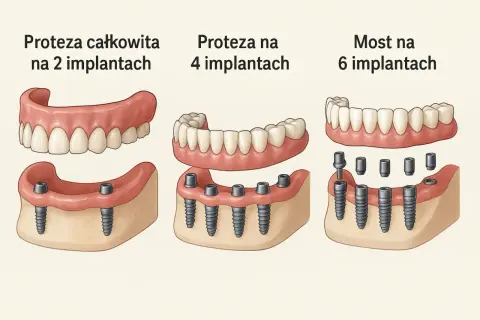 Nowoczesne protezy zębowe całkowite cena zależy od liczby implantów: na 2, 4 lub 6.