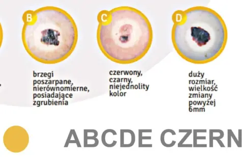 ABCDE czerniaka: asymetria, brzegi, kolor, duży rozmiar, ewolucja. Zmiany na ustach mogą być niepokojące.