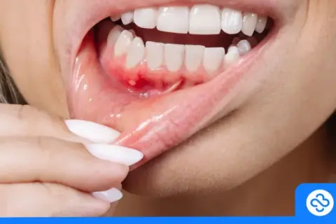 Opuchnięte dziąsła: Domowe sposoby, które działają! Kiedy do dentysty?