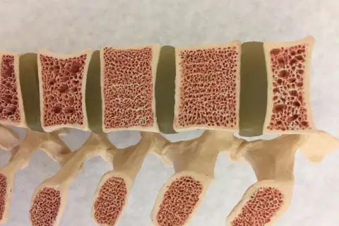 Model kręgosłupa z widocznymi ubytkami w kościach, ilustrujący osteoporozę objawy.