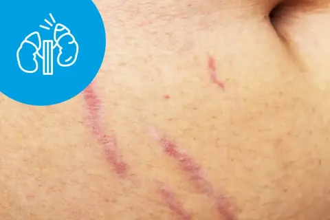 Rozstępy na skórze, symbol nerek w okręgu. Objawy zespołu cushinga mogą obejmować zmiany skórne.