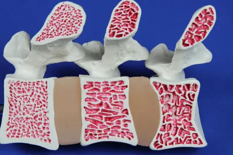 Model kręgosłupa z widoczną strukturą kości. Po lewej kość zdrowa, po prawej widoczne ubytki świadczące o osteoporozie.