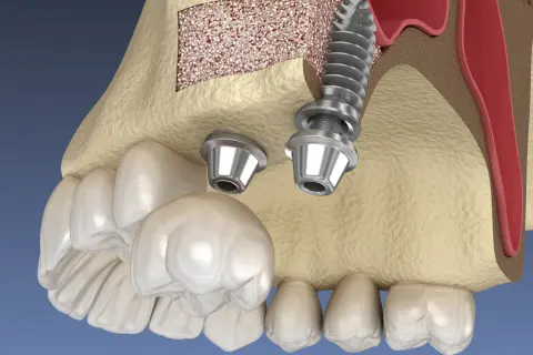 Model szczęki z implantami i podniesionym dnem zatoki szczękowej. Zabieg sinus lift pozwala na wszczepienie implantów w przypadku braku kości.