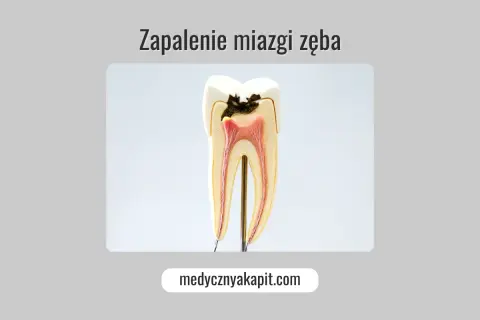 Model zęba ukazujący próchnicę sięgającą miazgi, co może prowadzić do zapalenia miazgi.