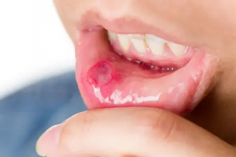 Afta a dentysta: Kiedy iść, a kiedy przełożyć wizytę?
