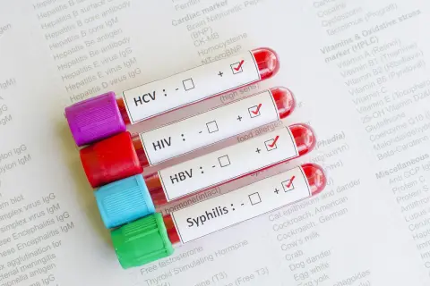 Próbki krwi do badań na choroby weneryczne: HCV, HIV, HBV, kiła. Wyniki testów na papierze.