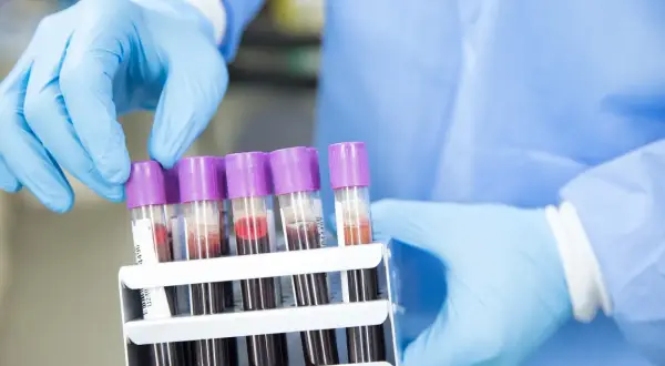 Ręce w niebieskich rękawiczkach trzymają stojak z probówkami krwi. Anty TG cena badań jest kluczowa dla diagnostyki.