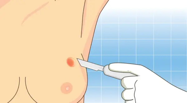 Lekarz w białej rękawiczce wykonuje biopsję cienkoigłową podejrzanej zmiany na piersi.