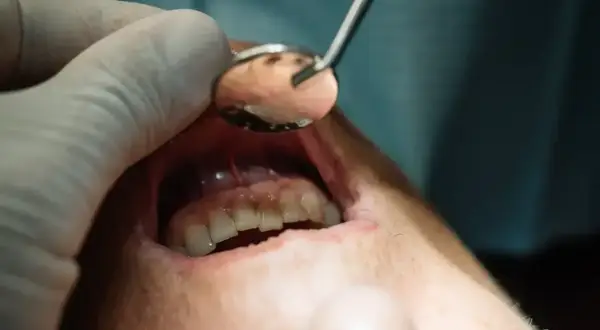 Stomatolog bada zęby pacjenta. Lusterko dentystyczne pomaga ocenić stan jamy ustnej, szukając przyczyn bólu zęba.