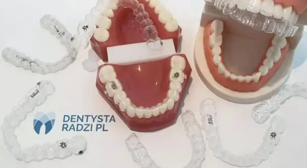 Koszt aparatu ortodontycznego w Polsce: Wszystkie wydatki, raty, NFZ
